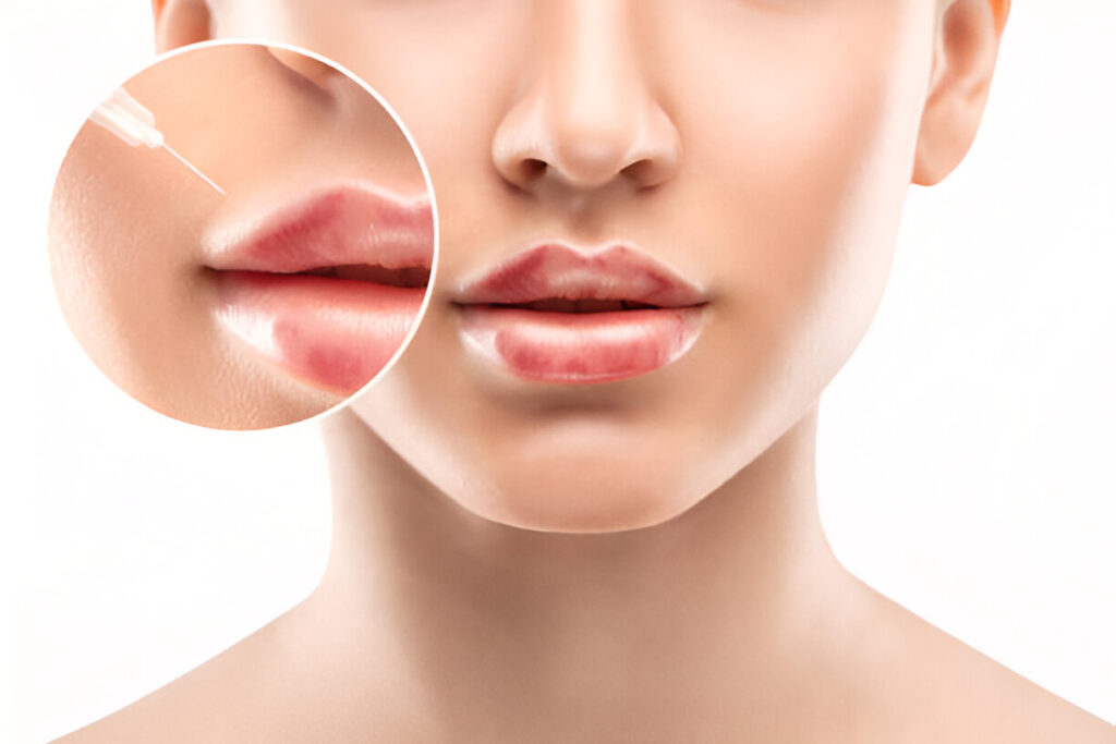 tratamento de preenchimento labial